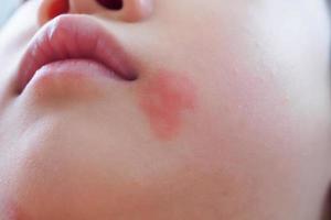 poco asiatico ragazza pelle eruzione cutanea e allergia con rosso individuare causa di zanzara mordere a viso foto
