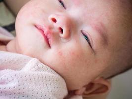 neonato bambino con allergia su viso foto
