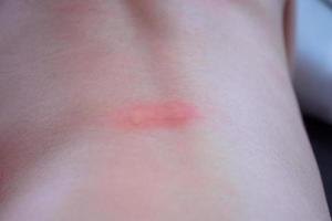 poco asiatico ragazza pelle eruzione cutanea e allergia con rosso individuare causa di zanzara mordere a indietro foto