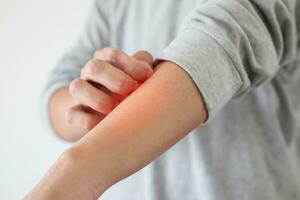 giovane asiatico uomo pizzicore e graffiare su braccio a partire dal prurito asciutto pelle eczema dermatite foto