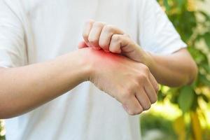 uomo pizzicore e graffiare su mano a partire dal allergia pelle eruzione cutanea causa di insetto mordere all'aperto foto