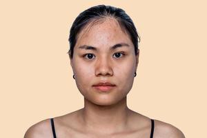 la giovane donna asiatica si preoccupa per il suo viso quando ha problemi con la pelle del viso in uno sfondo naturale. problemi con acne e cicatrici sulla pelle femminile. problema di cura della pelle e concetto di salute. foto