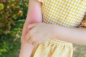 poco ragazza ha pelle eruzione cutanea allergia e prurito su sua braccio foto