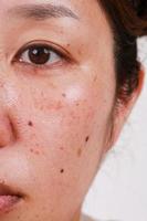 macro pelle, viso, donna, ritratto con grande pori buio macchie cura per problema pelle con foto