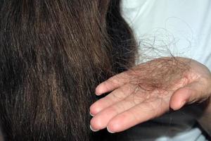 il ragazza detiene un' mazzo di caduto capelli nel sua mani. mano vicino su. capelli perdita problema. foto