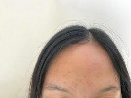 acne su il viso di asiatico donna. bellezza e pelle problema concetto foto