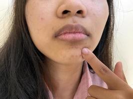 acne su il viso di asiatico donna. bellezza e pelle problema concetto foto