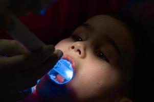 ultravioletto leggero nel odontoiatria, il dentista detiene un' dispositivo con ultravioletto leggero per velocemente foca il Riempimento nel il del bambino dente. foto