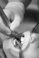 dentista pulisce dente decadimento nel un' bambino con un' trapano, nel il del bambino bocca espulsore saliva. foto