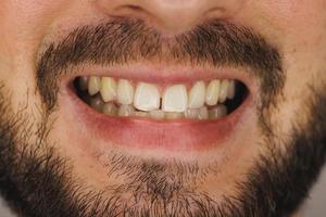 vicino su di un' denti di un' giovane uomo mentre preparazione per ortodontista foto