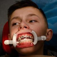 visitare per il ortodontista, installazione di bretelle su il superiore denti, bianca retrattore su il labbra di il bambino. foto