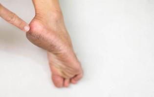 piedi con asciutto pelle per mostrare di il malsano piede. dovere essere spesso trattamento nel ogni giorno. foto