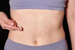 rash allergico rosso sulla pelle del ventre, dermatite atopica, eczema, infiammazione. donna che applica un unguento foto
