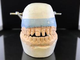 collassabile dentale gesso modello nel il occlusore di il superiore e inferiore mascella di un' persona per il produzione di ceramica corone. dentale laboratorio, clinica. dentale protesi foto