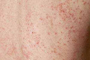 allergico eruzione cutanea su pelle. donna con dermatologia problema su indietro pelle foto