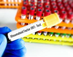 sangue campione rf o reumatoide fattore o RA o reumatoide artrite test, diagnosi per reumatoide artrite patologia. foto