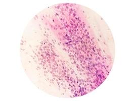 microscopico Visualizza di trichomonas vaginalis nel pap sbavatura con pochi acuto infiammatorio cellule. foto