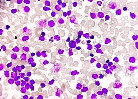 sangue sbavatura sotto microscopia mostrando cronico linfoblastico leucemia o cll foto