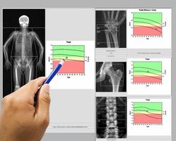 speciale visita medica medico Immagine osso densità un' femmina 65 anno vecchio totale corpo e polso, anca, colonna vertebrale, immagine pure sfocato quando visualizzazioni pieno soluzione, medica e tecnologia concetto. foto