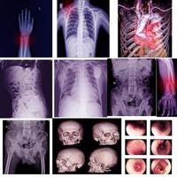 collezione raggi X multiplo parte di umano ortopedico chirurgia multiplo malattia osteoartrite ginocchio, spondilosi, ictus, frattura osseo, polmonare tubercolosi. foto