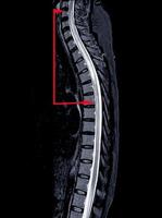 mri di toracica colonna vertebrale storia un' 53 anni donna, presentata con paresi e parestesia di tutti e due gambe acuto trasversale mielite. foto