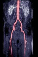 mra addominale aorta con addominale aorta. foto