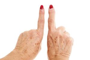 vecchio donna di mani deforme a partire dal reumatoide artrite foto