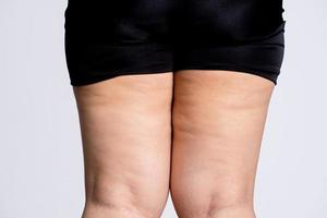 femmina gambe con cellulite. pelle e corpo cura concetto. foto