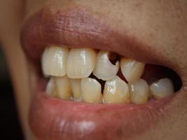 decomposizione mascellare denti foto