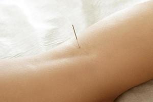 femmina gambe con acciaio aghi durante procedura di agopuntura terapia foto