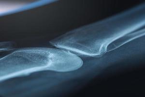 raggi X di umano ginocchio. i problemi con osso o giunto. foto