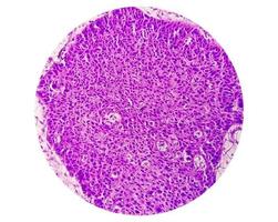 microfotografia mostrando lingua squamoso cellula carcinoma grado ii. orale dilagante sccc. foto