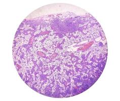 microfotografia di stomaco adenocarcinoma. gastrico adenocarcinoma. foto