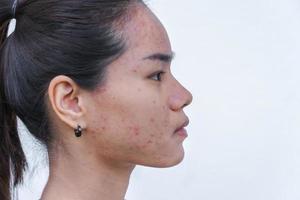 primo piano di una giovane donna asiatica che si preoccupa del suo viso quando ha problemi con la pelle del viso. problemi con acne e cicatrici sulla pelle femminile. problema di cura della pelle e concetto di salute. foto