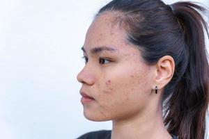 primo piano di una giovane donna asiatica che si preoccupa del suo viso quando ha problemi con la pelle del viso. problemi con acne e cicatrici sulla pelle femminile. problema di cura della pelle e concetto di salute. foto