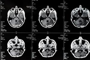 mri con cervello tumore. magnetico risonanza imaging. foto