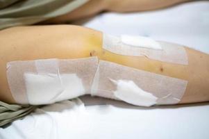 il vecchio signora donna paziente mostrare sua cicatrici chirurgico ferita chirurgia a partire dal il rotto gamba su letto nel assistenza infermieristica ospedale reparto. foto
