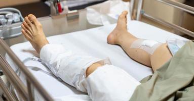 il vecchio signora donna paziente mostrare sua cicatrici chirurgico ferita chirurgia a partire dal il rotto gamba su letto nel assistenza infermieristica ospedale reparto. foto