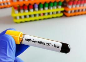sangue campione tubo per hs-crp o alto sensibile crp test, per il diagnosi di infiammatorio cuore malattia foto