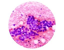 microfotografia di bene ago aspirazione citologia di un' polmonare nodulo mostrando adenocarcinoma, un' genere di non piccolo cellula carcinoma. foto