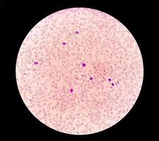 sangue film sotto microscopico mostrando microcitico ipocromico anemia foto
