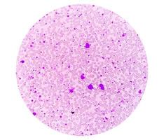 cronico mieloide leucemia o cml nel accelerato fase con trombocitosi. cronico mieloide leucemia. foto