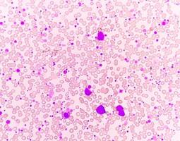 cronico mieloide leucemia o cml nel accelerato fase con trombocitosi. cronico mieloide leucemia. foto