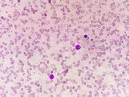 sangue film sotto microscopico mostrando microcitico ipocromico anemia foto