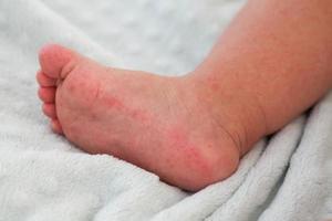 un' piccolo bambino con un' rosso eruzione cutanea su il gamba si siede su il letto. bambini è allergie. foto