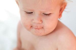 ritratto di un' bambino con un' eruzione cutanea vicino il bocca. enterovirus, allergia nel un' ragazzo. foto