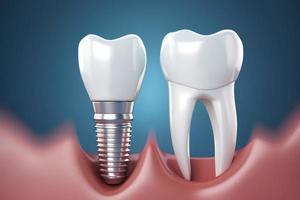 realistico dentale impiantare. denti trattamento. creare ai foto