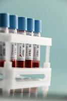 campioni di sangue per il test covid in laboratorio foto
