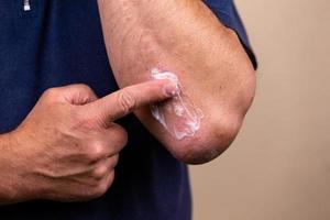 foto di concetto di trattamento delle malattie della pelle utilizzando unguenti come dosaggio