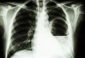ascesso polmonare film radiografia del torace pa in posizione verticale mostra ascesso polmonare sinistro